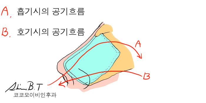  만성비염수술과 비중격만곡증 수술로 코골이 수면무호흡을 해결하자