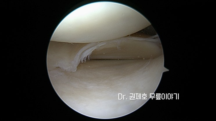 반월상연골절제술 무릎관절경  으로 닳은 부위 심플하게