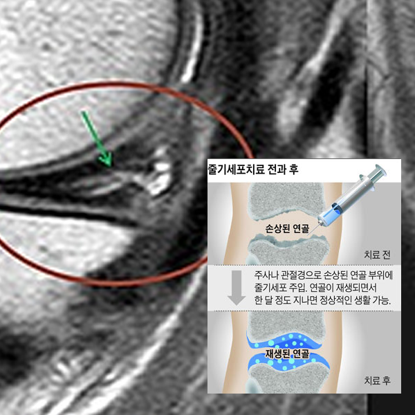 무릎 연골 수술 연골 콜라겐 채우는 시술 : 네이버 블로그