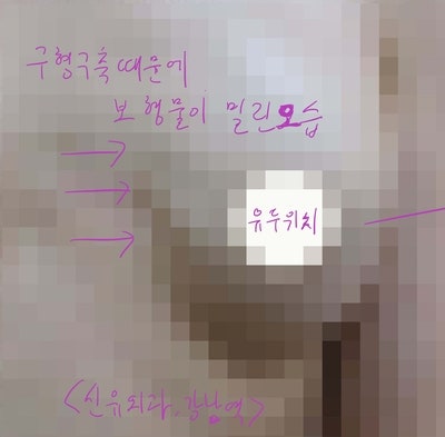 구형구축때문에 밀린 보형물을 가슴성형재수술(부분마취로)하여 교정