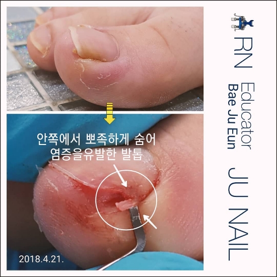 염증발톱안에뾰족한발톱이/분당용인수원수지보정동백죽전동/주네일/파고드는발톱 