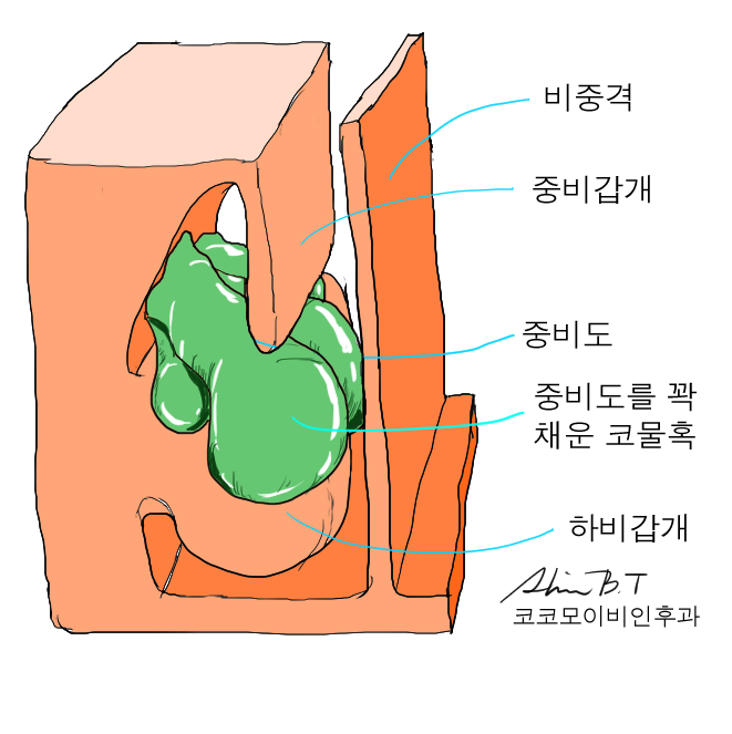  코 물혹에 의한 후각상실은 내시경 코물혹  수술로 해결