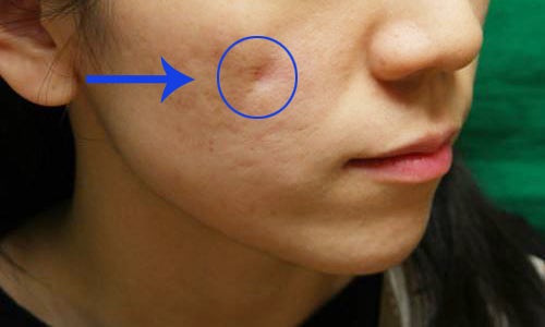 지방이식 만져? 부작용? 제거? 4
