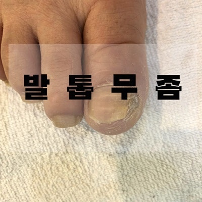 창원/마산 발톱무좀 관리 전문네일샵 네일더스타일