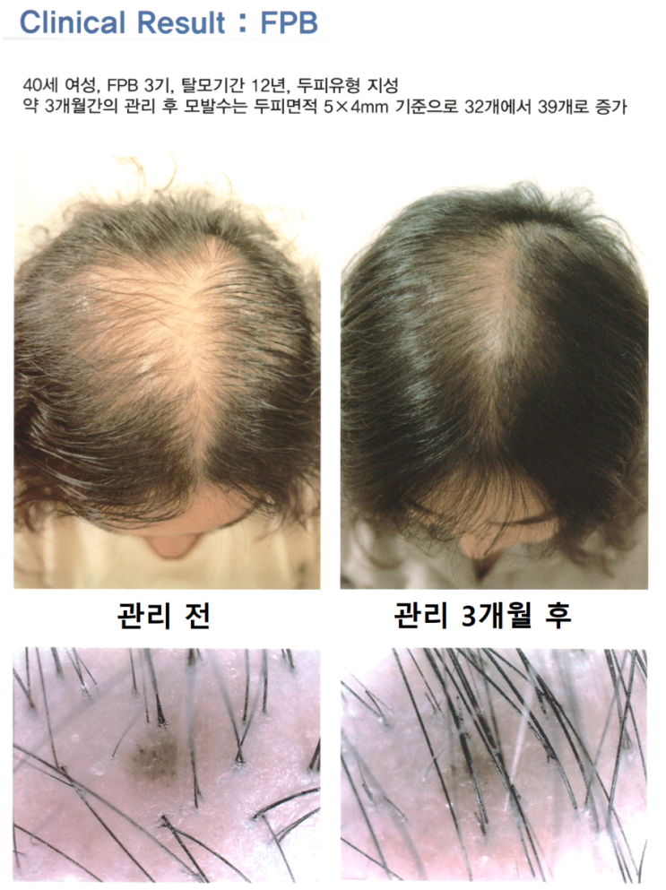 40세 여성,FPB 3기,관리기간 3개월,강서구탈모,탈모기간 12년 관리전후 사진, 상암동 탈모 각질 건선 두피, 상암역 탈모. 40세 여성,FPB 3기,관리기간 3개월,강서구탈모,탈모기간 12년 관리전후 사진, 상암동 탈모 각질 건선 두피, 상암역 탈모.