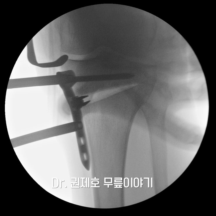  경골근위부절골술 휘어진 다리 교정하여 관절염 예방