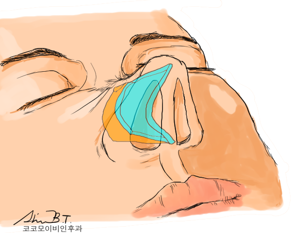  비중격교정술로 코 기능과 구조를 한번에 개선하자