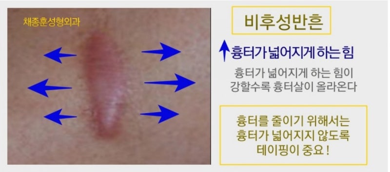 수술 후 흉터에 대하여 - 흉터, 켈로이드, 비후성 상처, 흉터 연고의 원인