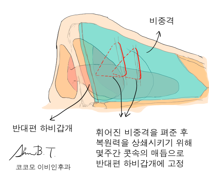  비중격교정술에서 지혈솜을 적게 넣어 통증을 최소화하는 방법