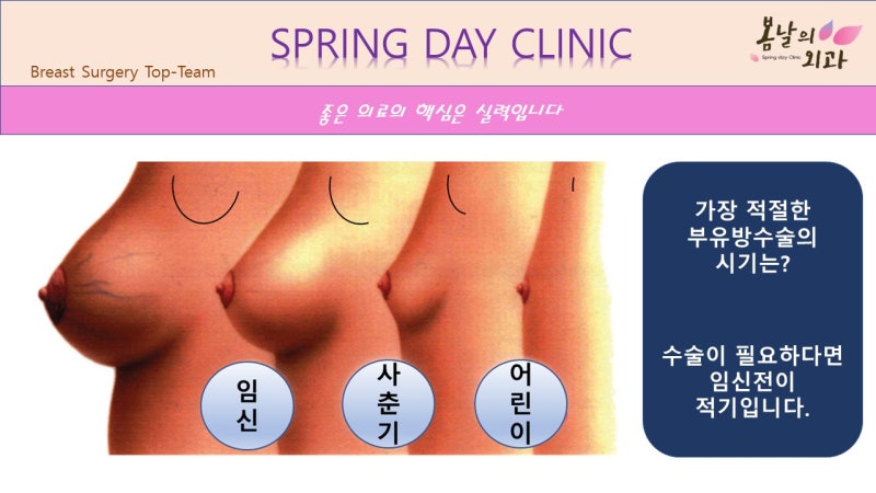 부유방수술 중요한 점으로는 5