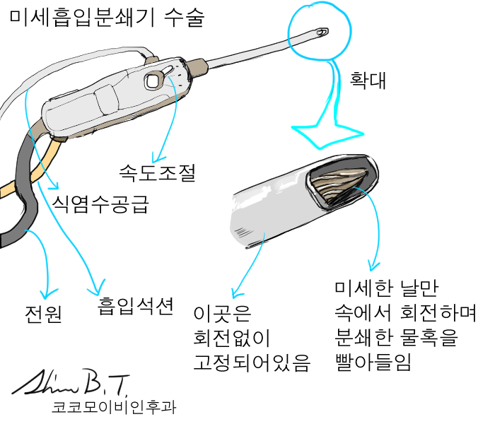  코물혹수술 전과정 알기쉬운 그림설명