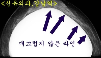 뒤늦게 염증 발견되어 가슴보형물제거수술하신 분