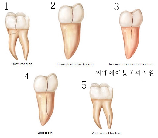 치아 크랙, 5가지 분류에 대한 정리