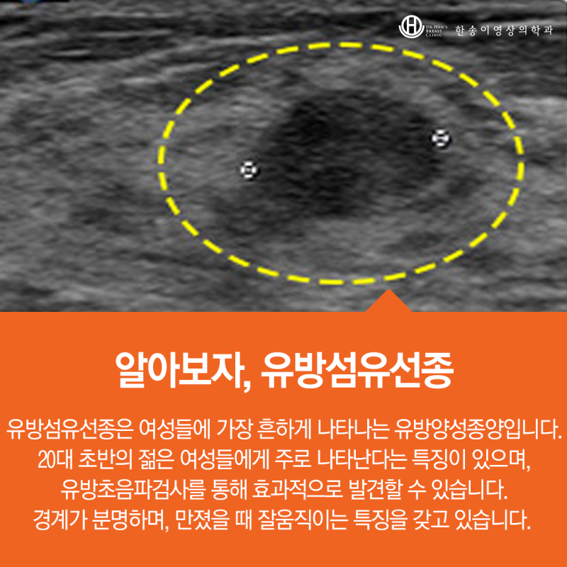 유방의 섬유선종을 나타낼 수 있는 증상 7