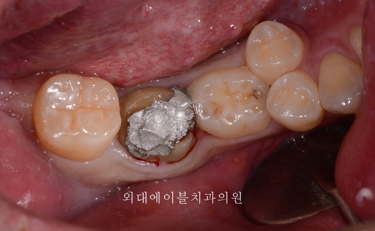 살릴수 있는 치아 vs 살릴수 없는 치아 2편 - 외대에이블치과, 치아를 살릴수 없는경우, 충치가 깊을때