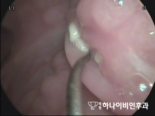 목의 이물감 편도결석이 원인일지도 모른다