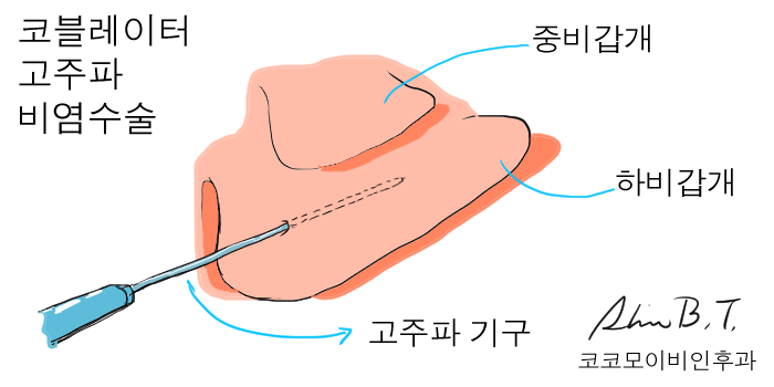  만성 비염수술 알레르기비염에서도 하나요?