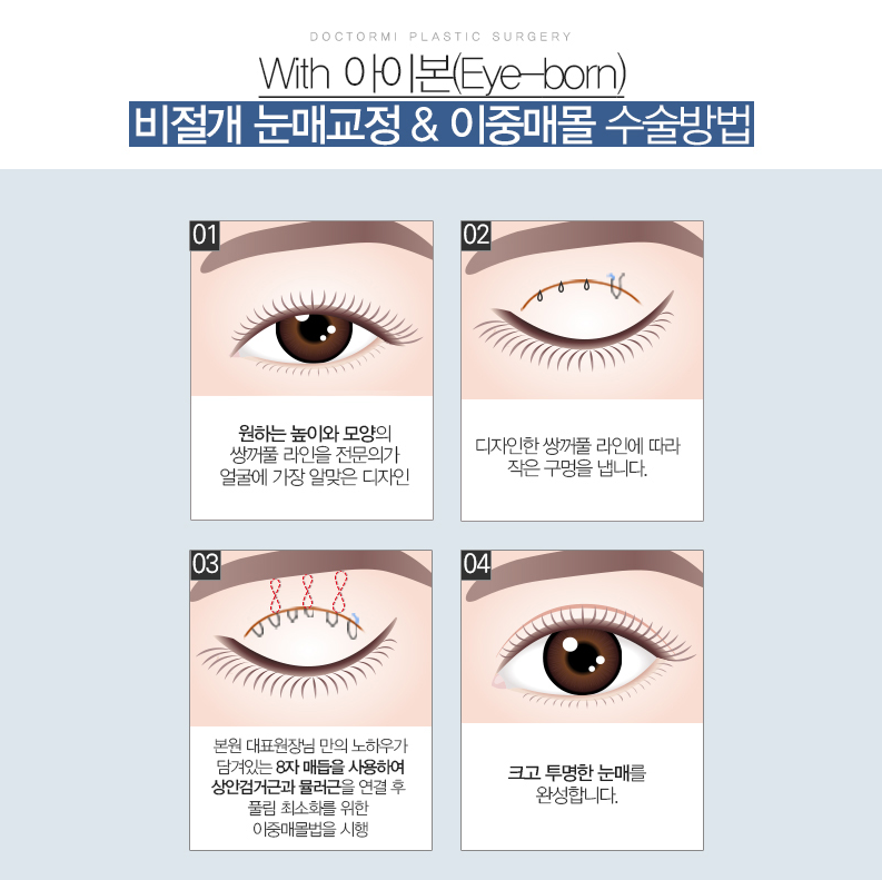 섹시한 눈을 원한다면 쌍꺼풀 리프팅 수술 4