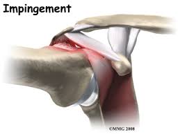  어깨 충돌증후군 도수치료 사례  (shoulder impingement syndrome  case study)