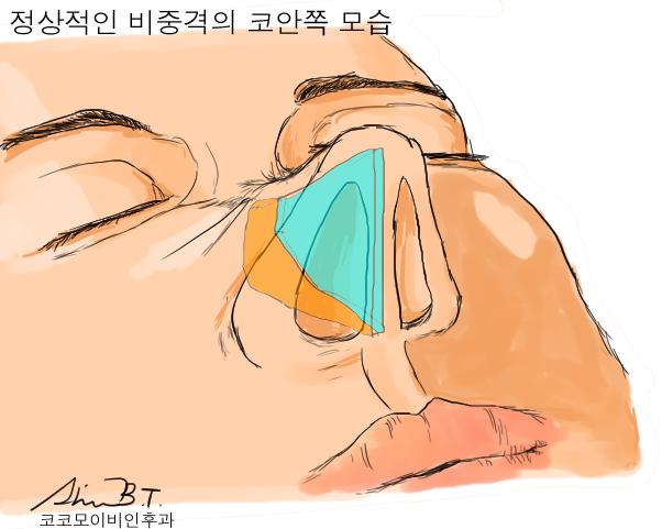  비중격만곡증수술로 코 증상 완치할 수 있어