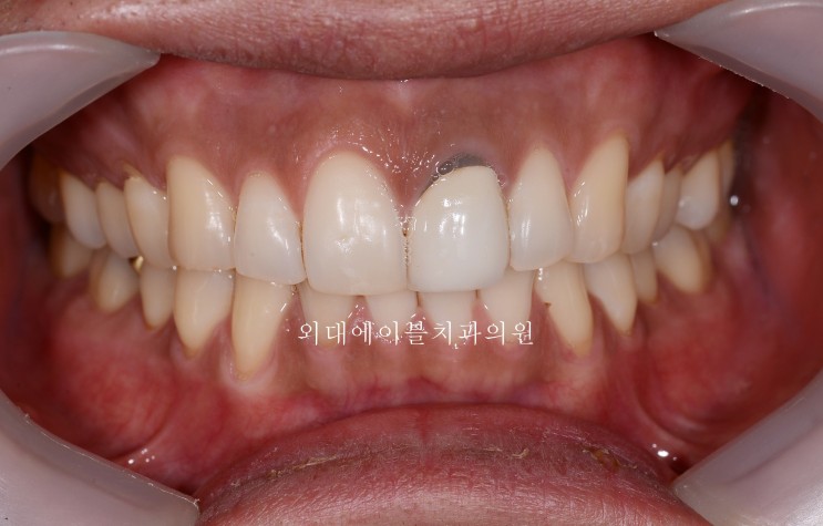 변색 치아의 보철만을 이용한 해결 - 변색치아 치료법