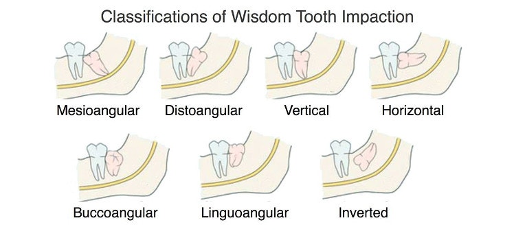 앙와위 사랑니 발치