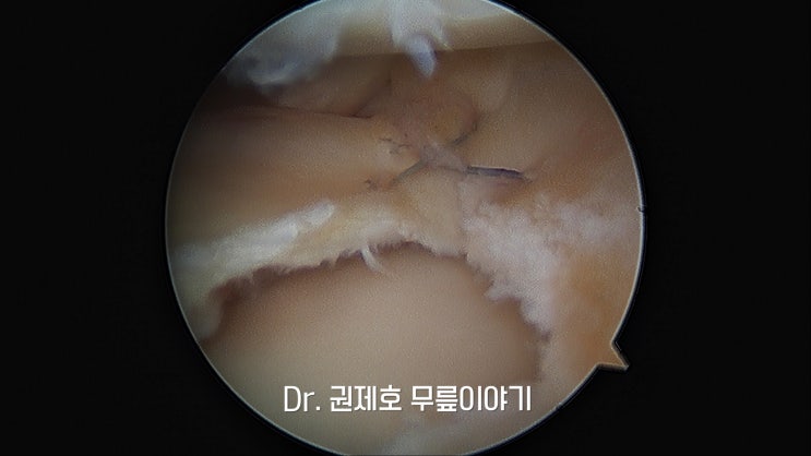  반월상 연골 파열 재활 절제와 봉합의 차이