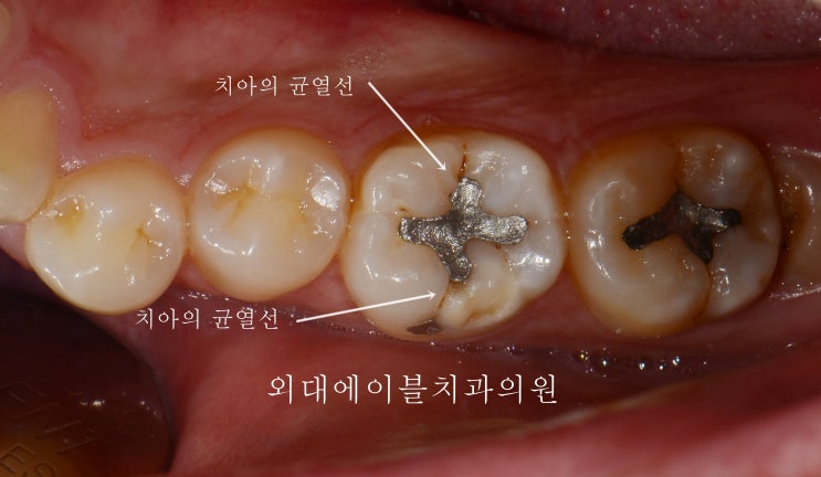 [이문동, 회기동 치과] 아말감 치료 재치료