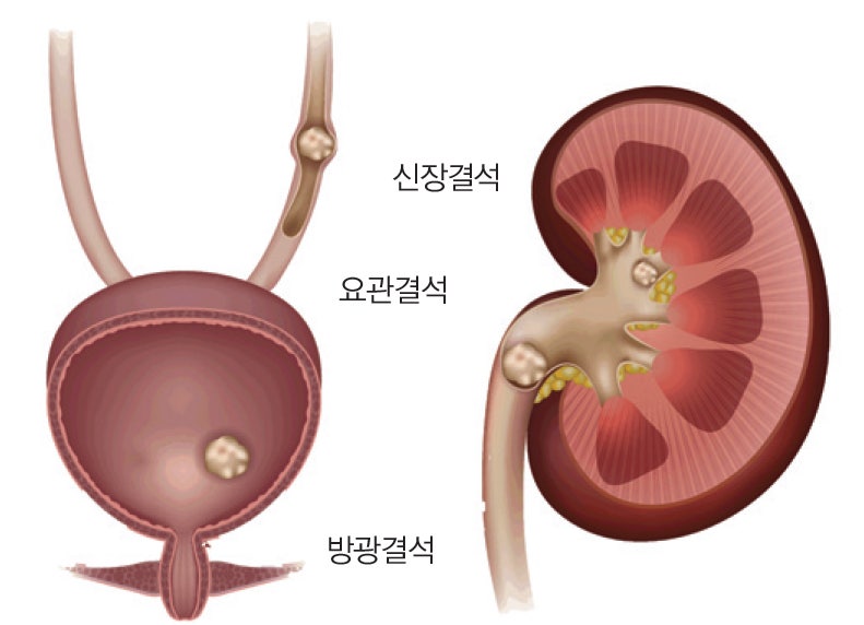 인천 요로 결석 24시 치료 가능하다?
