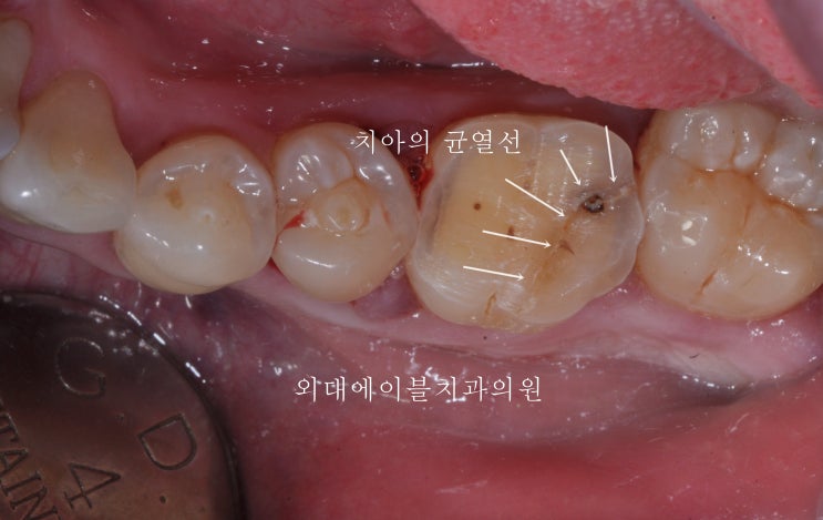 [이문동, 회기동 치과] 치아의 균열선, 치아에 금간것, 금이 간 치아
