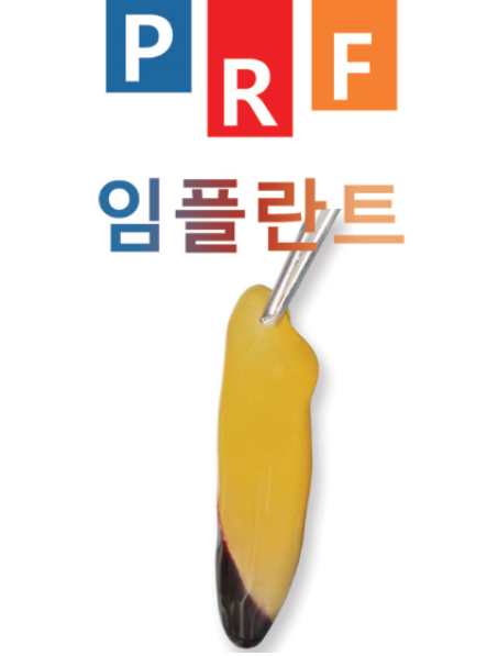  [대전램브란트치과] 자가혈이식(PRF) 임플란트