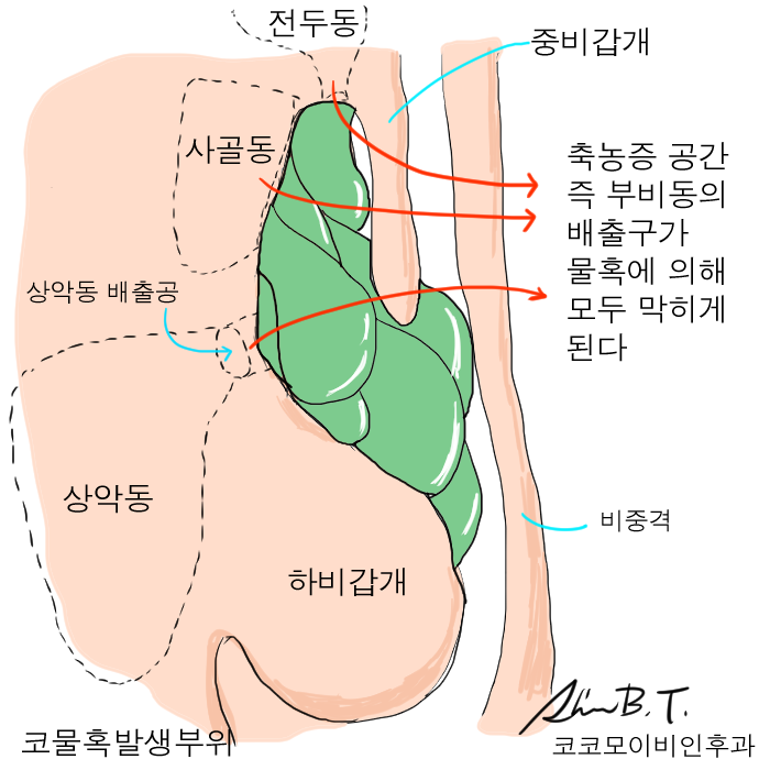 코맹맹이 소리 코물혹수술로 해결했어요