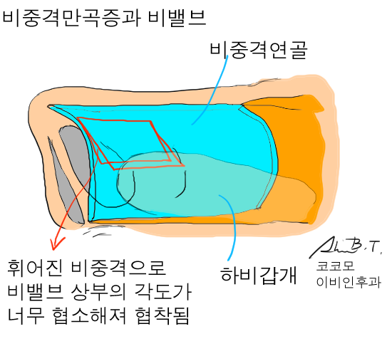  비중격만곡증수술이 실비보험 적용이 될까?