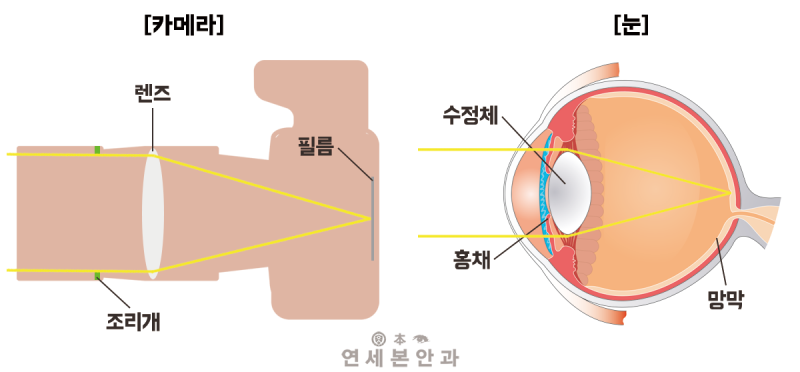 [인제안과] 망막 열공 어떤 증상이 있나요? 2
