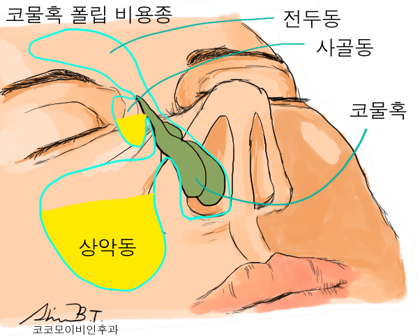 코물혹과 그외 한쪽 코막힘을 유발하는 코 질환들