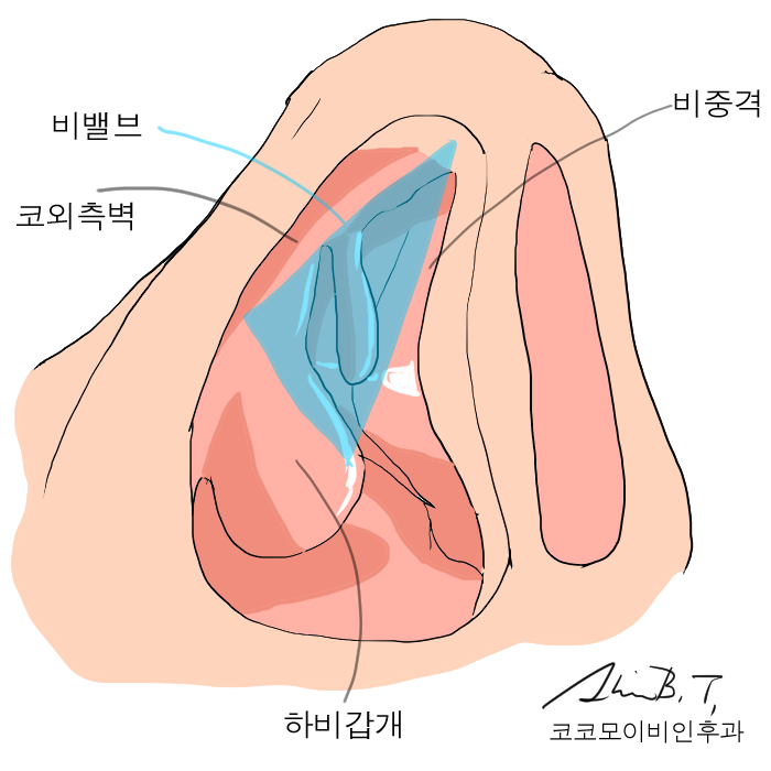  만성 비염수술에서 고려해야할 핵심체크
