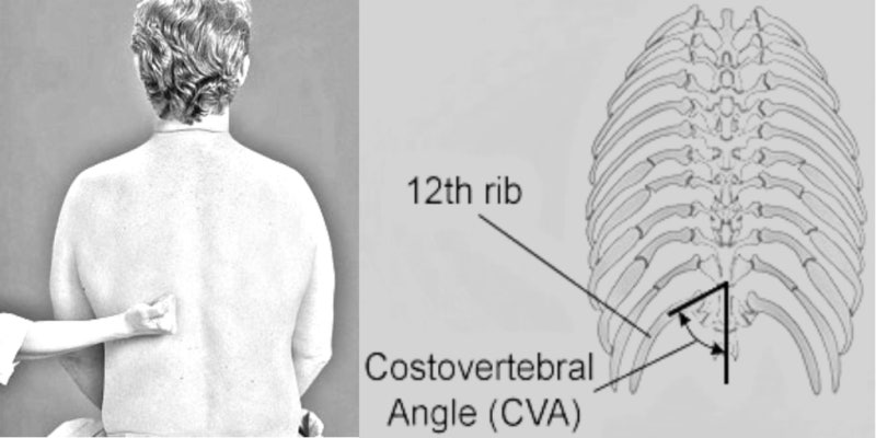 등을 두드리면 아픈 증상, 갈비 9