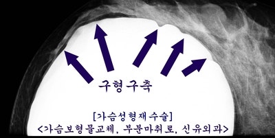 구형구축 피막제거도 하고 보형물교체, 맘모톰도 했던 가슴성형재수술