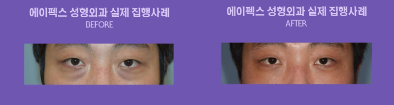 눈밑지방재배치로 다크서클 해결!