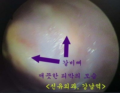 비유착되어 회전된 물방울가슴보형물을 제거교체하며 부분마취로 성형재수술