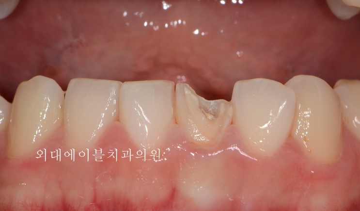 살릴수 있는 치아 vs 살릴수 없는 치아 5편 - 뿌리 끝에 염증이 매우 큰 경우, 치아 뿌리 염증, 치근단 염증