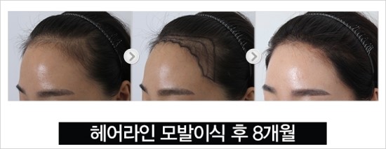 르지 않은 이마라인 해결은 1