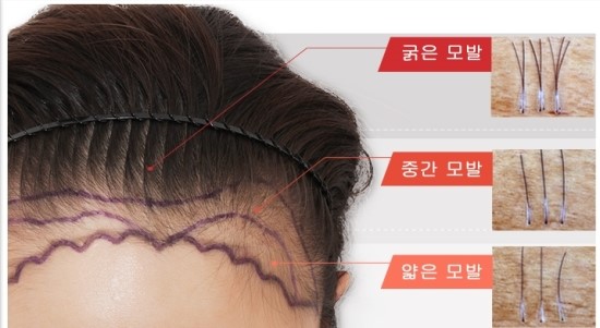 르지 않은 이마라인 해결은 4