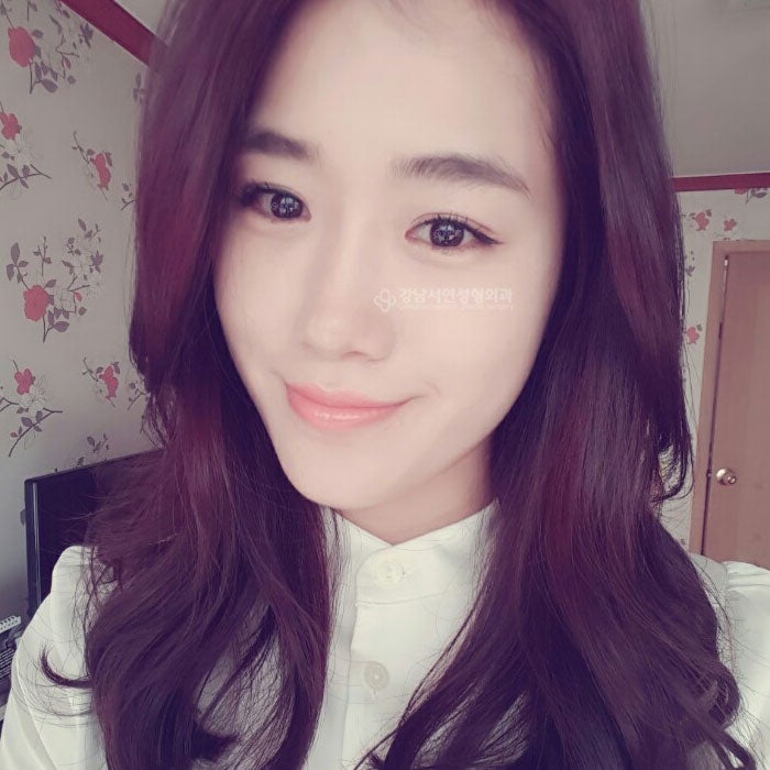 쌍꺼풀수술이란?