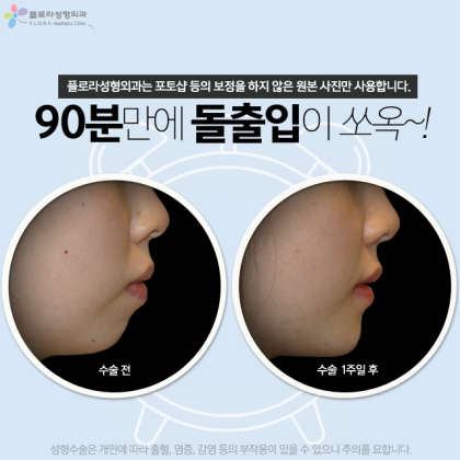 [대전교정치과] 서울브라운치과 돌출구 교정으로 웃음 찾기 3
