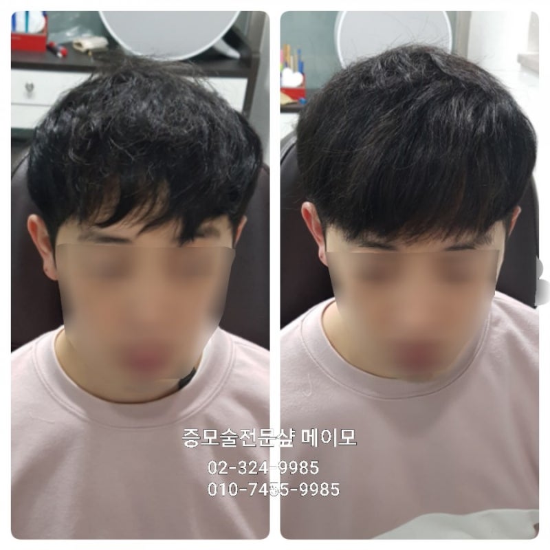 남자 헤어증모술 가격 행사 놓치면 안될것 같아요 5