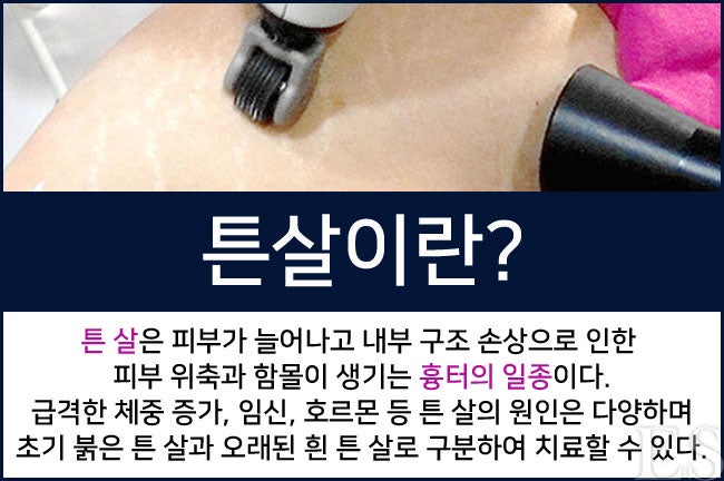 수두흉터 치료 피부 재생을 6