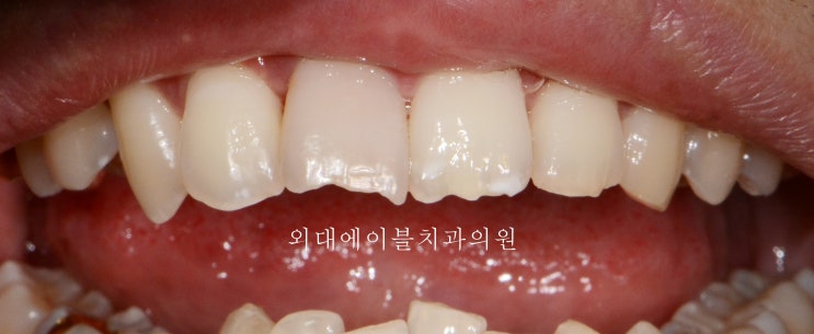 [이문동, 회기동 치과] 앞니 뿌리 염증이 큰경우 - 앞니 변색, 이빨 변색