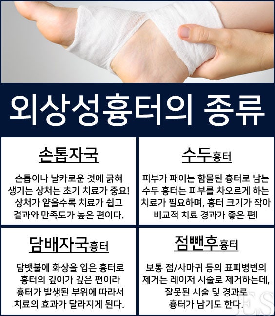 수두흉터 치료 피부 재생을 2