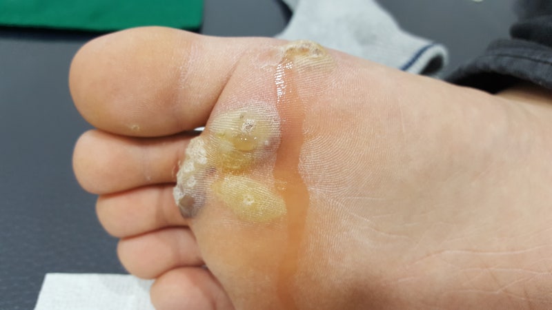 인덕원역 피부과 사마귀 종류와 치료 - 냉동/레이저 치료